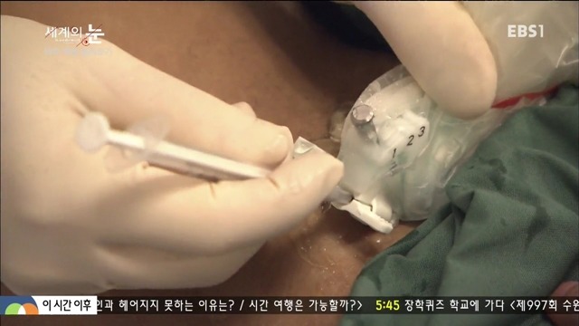 다큐 세계의 눈 - 의학 혁명 알레르기 | 인스티즈