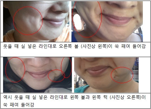 매선 부작용 후기 (매선 하지 마세요) | 인스티즈